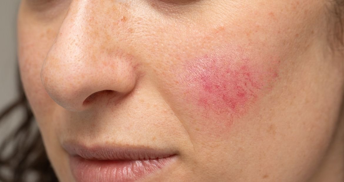 Mulher com mancha vermelha no rosto.